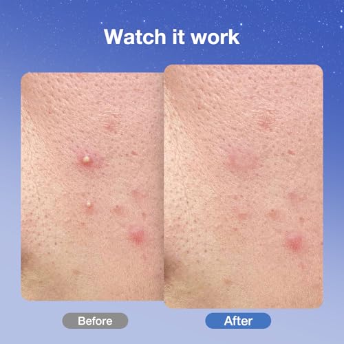 Save 50% on Overnight Pimple Patches – 36 Count - Image 5